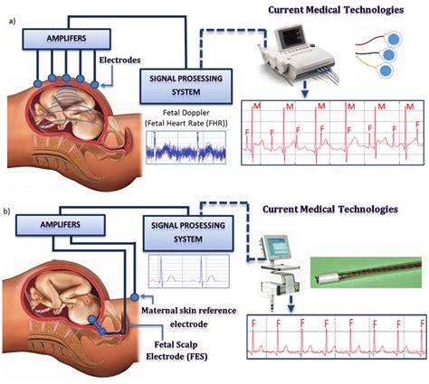 doppler maternaler gefäße|Novel Method for Fetal and Maternal Heart Rate ...